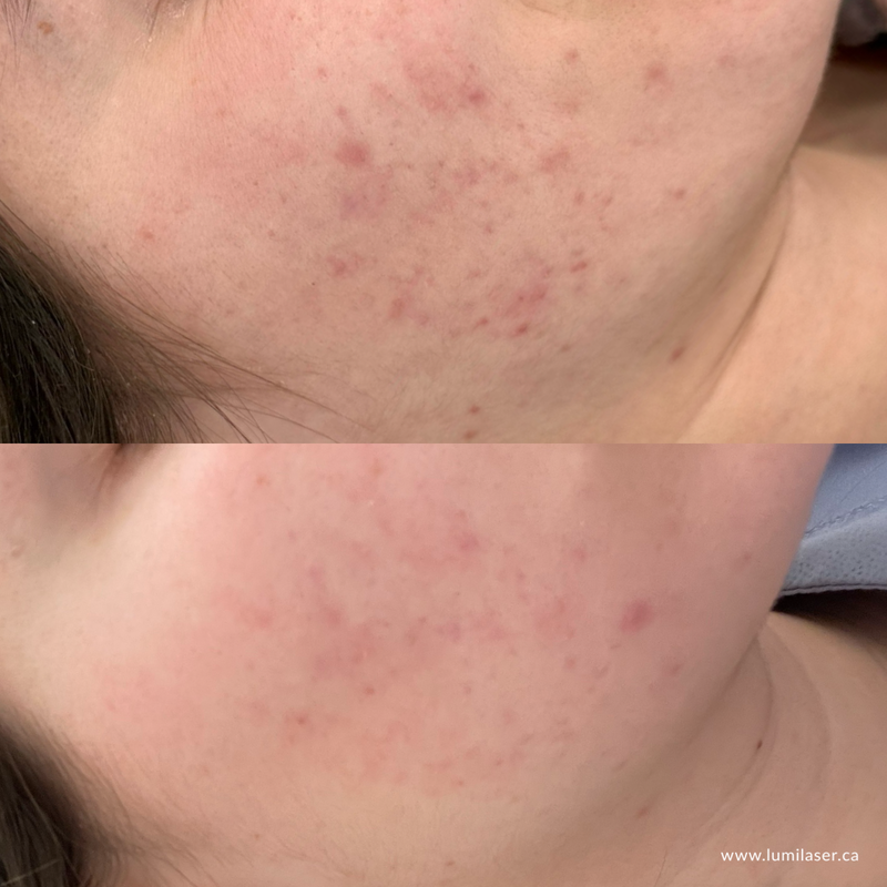 Results Micro Infusion, MicroChanneling, Microneedling, Dermal Stamping Facial in Montreal, Quebec, Canada, Lumilaser Esthetics, Eve Mamane