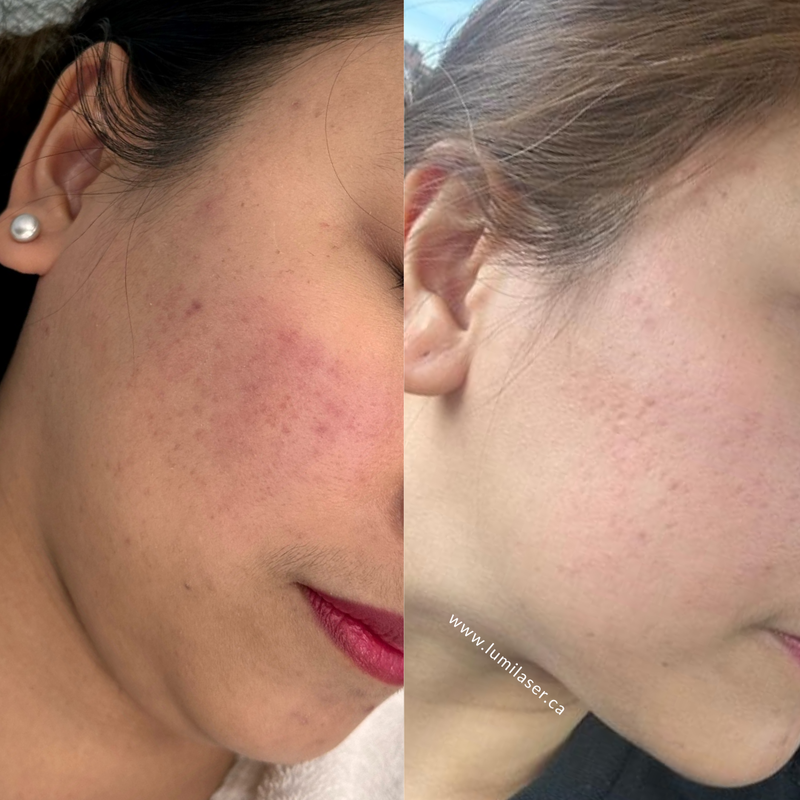 Results Micro Infusion, MicroChanneling, Microneedling, Dermal Stamping Facial in Montreal, Quebec, Canada, Lumilaser Esthetics, Eve Mamane